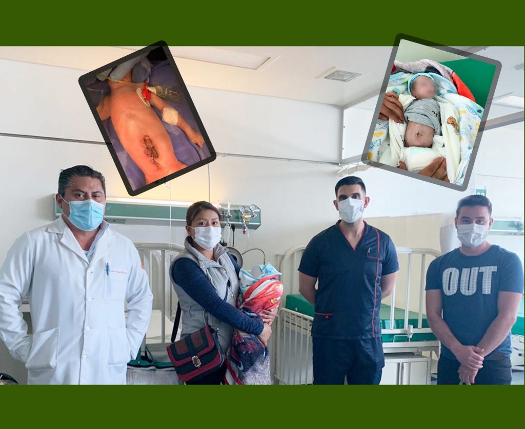 Atiende IMSS de Irapuato caso de menor con intestinos expuestos; salvan su vida y la de su madre